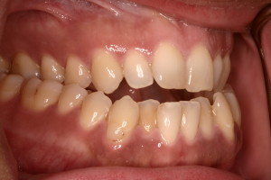 Posterior cross-bite with anterior open bite.