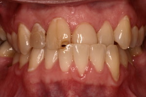 Partial anterior cross-bite with damage to front teeth.