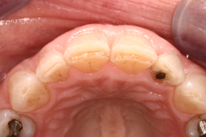 Exposed dentin on upper front teeth due to moderate wear.
