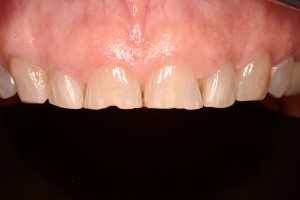 Chipped and worn teeth due to moderate wear.