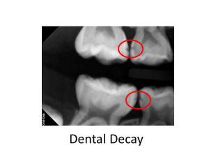 Pediatric dental decay Dr Peter G. Lemieux