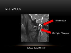 Assessment of TMJ issues via Imaging