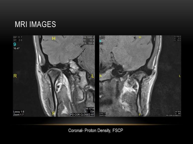 Assessment of TMJ issues via Imaging